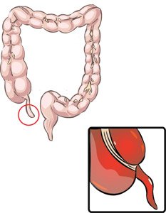 Σκωληκοειδής απόφυση - Appendix